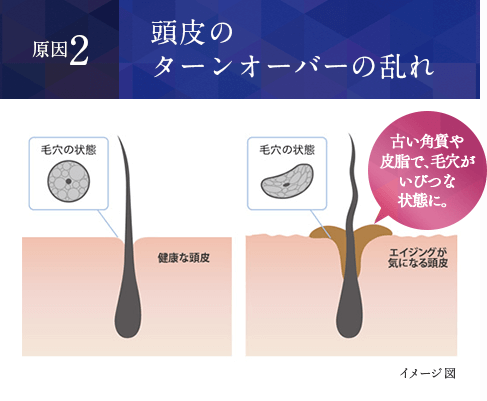 頭皮のターンオーバーの乱れ