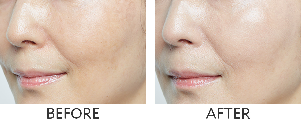 ビフォーアフター比較写真